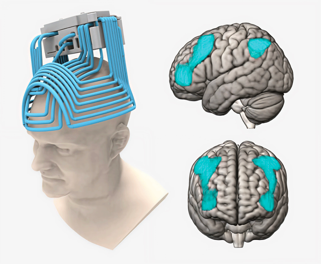 graphic of the H1 TMS coil