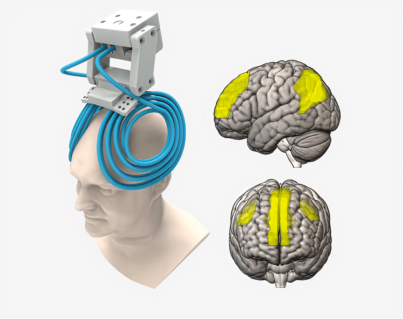 graphic of the H7 TMS coil